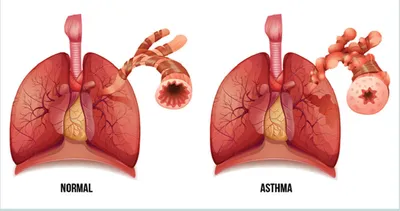 Бронхиальная астма: 10 триггерных факторов астмы - FxMed - ЦЕНТР  МОЛЕКУЛЯРНОЇ АЛЕРГОЛОГІЇ