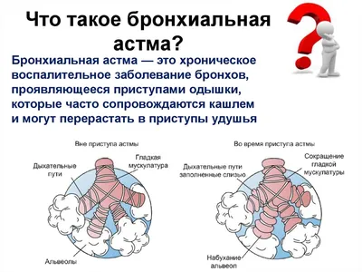 Бронхиальная астма: как диагностировать и лечить: описание, симптомы,  диагностика и лечение. Научный раздел клиники ИАКИ