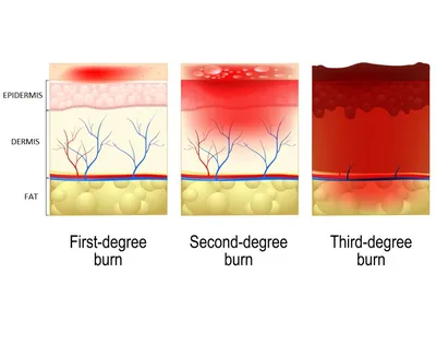 Cool Running Water Is Best Initial Treatment For Burns In Children, Study  Finds