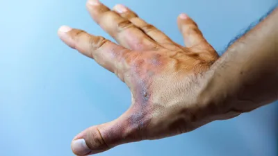 Burn stages. Burnt hands at various degrees. Skin burn symptoms. Medical  healthcare concept. Vector 24055159 Vector Art at Vecteezy