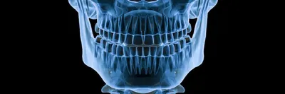 Вставная челюсть - фото, виды съемных челюстей, как их изготавливают?