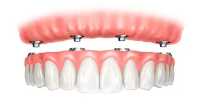 Имплантация нижней челюсти зубов цена и стоимость установки