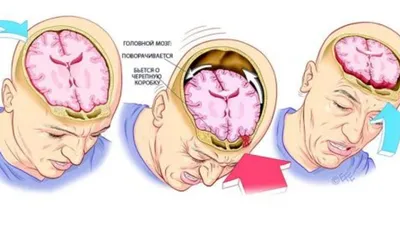 Черепно-мозговые травмы: симптомы, типы, лечение в Херсоне | Neuro.ks.ua.