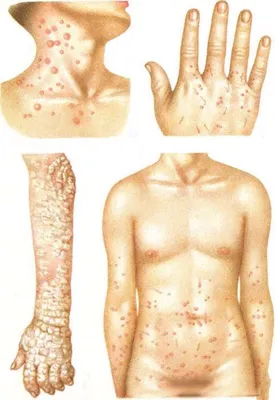 Случай №14. Чесотка… или о тех, кто не может жить без нашей кожи. | Сайт  дерматовенеролога Бетехтина М.С.