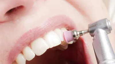 Как чистят зубы в стоматологии | Блог NOVA стоматологии Драганчука