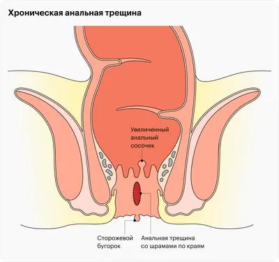 Долго сидеть на унитазе очень опасно!Узнай почему - YouTube