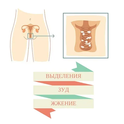 Молочница у женщин - симптомы и лечение кандидоза