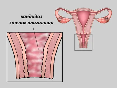 Лечение молочницы (Кандидоз) в Москве.