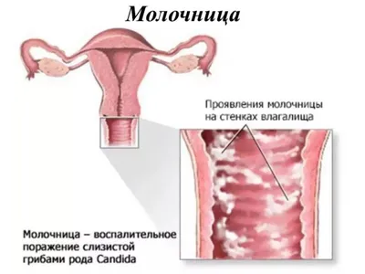 10 причин молочницы у женщин: что может вызвать молочницу и что делать,  чтобы от нее избавиться