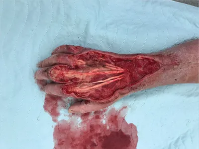 ❗️WARNING VERY GRAPHIC ❗️- Full degloving of the extremity. : r/medizzy