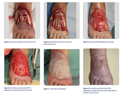 Graft surgery for degloving foot injury - Stock Image - C021/0863 - Science  Photo Library