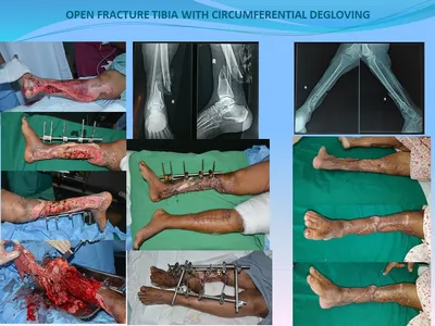 Trauma: Multiple finger degloving treated with medial cross arm flap and  temporary syndactyly