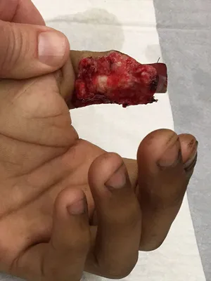 Right hand degloving injury – Medical Art Works