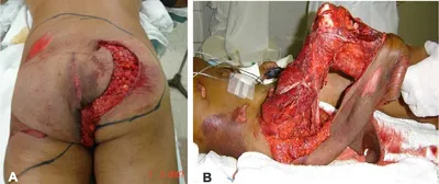 Case Report: Degloving Foot Injury Case Presentation | ePlasty