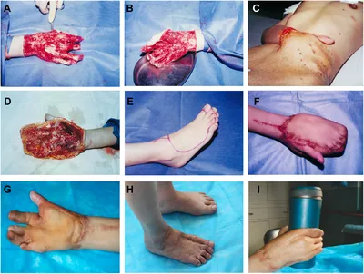 CRUSH INJURY FOOT, LOWER LIMB INJURIES AND LIMB SALVAGE: DEGLOVING INJURY  LEG AND KNEE - GROSSLY DISPLACED FRACTURE TIBIA EX - CROSS LEG FLAP AND  SKIN GRAFTING