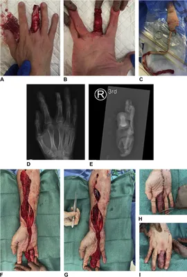Sandwich Flap Reconstruction for a Degloving Hand Injury - SciTeMed  Publishing Group