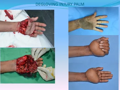What Causes Degloving of the Face? Understand the Risks