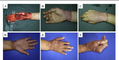 Management of Degloving Injuries of the Lower Extremity: A Case Report of a  Forklift Injury - Laura Zagrocki, Adrienne Ross, Adam Hicks, 2013