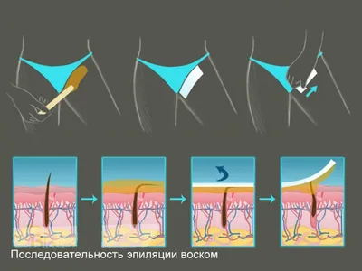 Шугаринг и восковая депиляция Запорожье