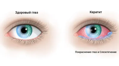 Гимнастика для глаз при катаракте