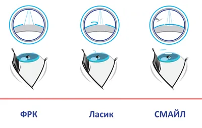 Современные методы коррекции зрения: какой выбрать и в чем разница? -  Hi-News.ru