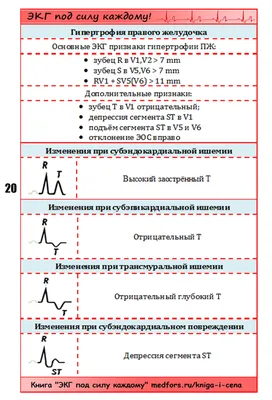 Абсолютно новая Шпора по ЭКГ | Медфорс