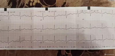 ЭКГ С НУЛЯ on Instagram: \"Алгоритм расшифровки ЭКГ с  электрокардиостимулятором! #экг #экгснуля #обучениеэкг #экс\"