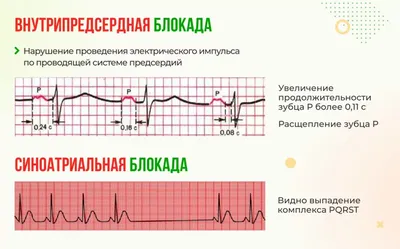 Определение электрической оси сердца