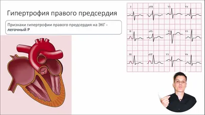 Паузы на ЭКГ. Разбор сложной ЭКГ. Блокированные экстрасистолы. - YouTube