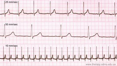Как быстро расшифровывать ЭКГ? (алгоритм быстрой расшифровки) - YouTube