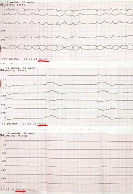 Кому нужно делать ЭКГ - Доктор Позвонков