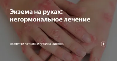 Экзема на руках и ногах: лечение в СПб в клинике МедПросвет | Клиника  МедПросвет