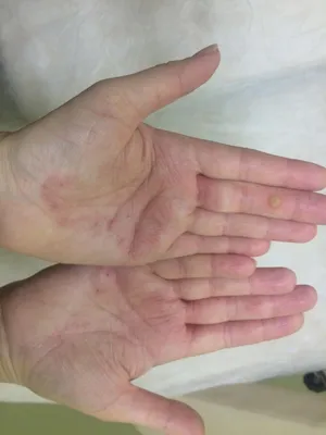 Экзема на руках: фото, лечение, причины, как выглядит на пальцах и как  навсегда избавиться от заболевания