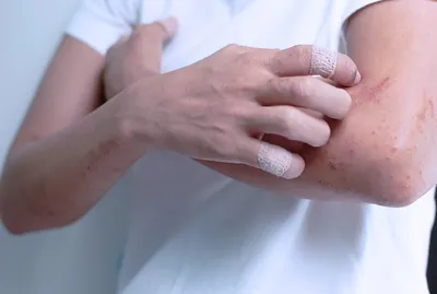Экзема на руках Женские руки, пострадавшие от дерматита Закрыть Стоковое  Фото - изображение насчитывающей вопрос, иносказательных: 163053006