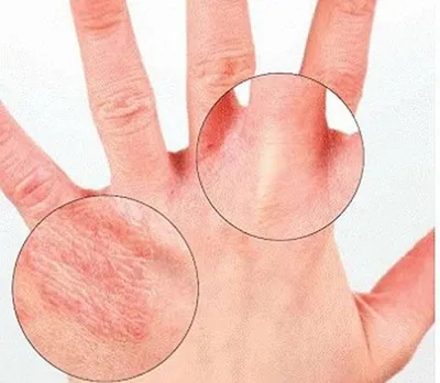 Сухая кожа рук и дерматит – что делать nail-мастеру и как предотвратить  заболевание?