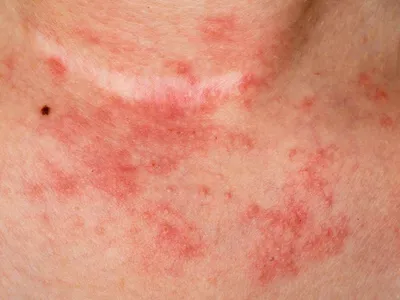 Мощный аллергия, экзема на руках. Красная некорректная кожа с волдырями  Стоковое Фото - изображение насчитывающей здорово, микстура: 211285758