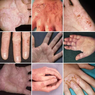Дисгидротическая экзема - это хроническое заболевание кожи, при которо... |  TikTok