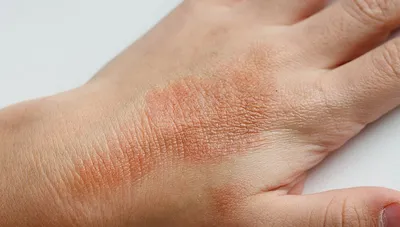 Экзема – группа воспалительных болезней кожи
