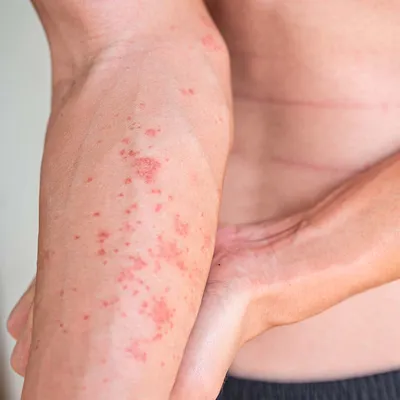 Экзема – неинфекционное хроническое заболевание кожи. Не заразно ☝🏼 На  фото: лечение экземы в течении 2 недель. ⠀ ПРИЧИНЫ: ➡️генетическая … |  Instagram