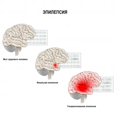 Эпилепсия - причины появления, симптомы заболевания, диагностика и способы  лечения