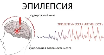 Эпилепсия - причины, диагностика, лечение