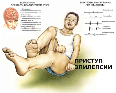 Если у человека случился приступ эпилепсии… | Оренбургский областной центр  общественного здоровья и медицинской профилактики