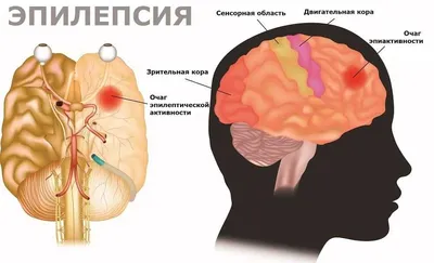 Эпилепсия. Что такое приступ эпилепсии – его причины, признаки и симптомы.