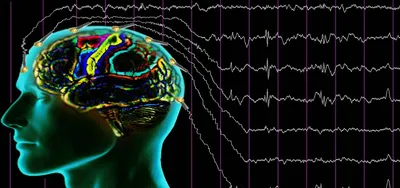 Эпилепсия | Лечение в Федеральном центре мозга