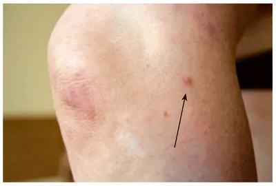 Некролитическая мигрирующая эритема — кожный признак глюкагономы