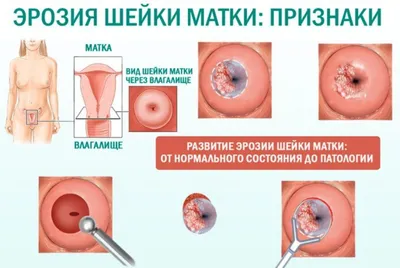 Эрозия шейки матки: симптомы и лечение в Ростове-на-Дону