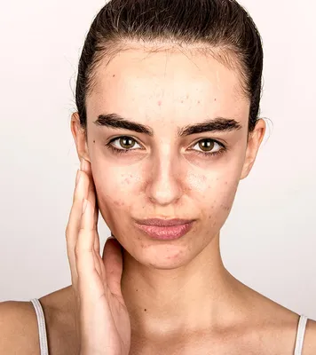 Causes of Dry Patches on Your Face and How to Treat Them Fast