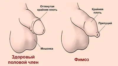 ᐈ Лечение фимоза в Киеве у детей и взрослых ~【МЕДИКОМ】