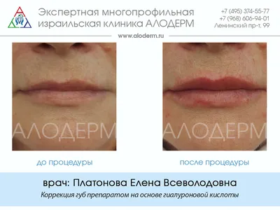 Коррекция формы и объема губ: цены в Москве, фото операций