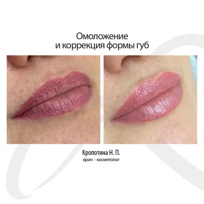 Dr. Mylips - Какая форма губ вам нравится больше всех?... | Facebook